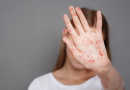 Vermont Department of Health Confirms Measles Case in Lamoille County